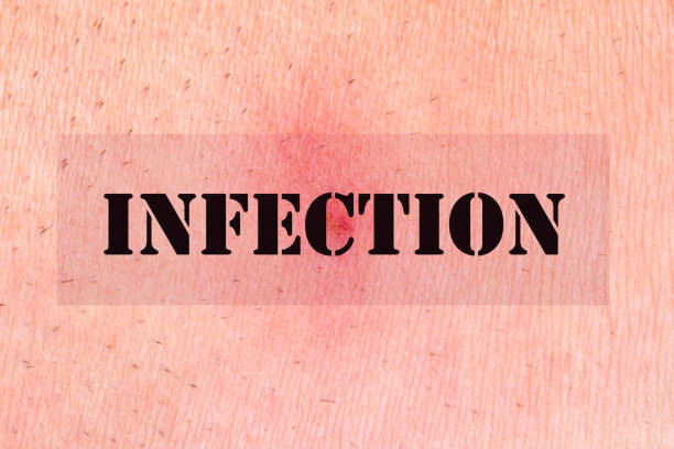 The word infection over human skin background. The word infection over human skin background.