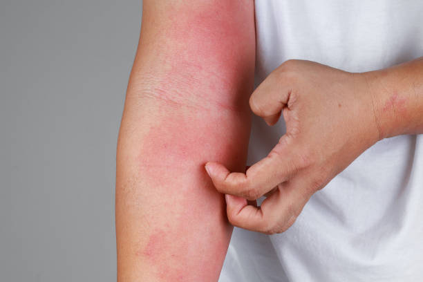 A close-up of bad psoriasis on a person's arm A close-up of bad psoriasis on a person's arm